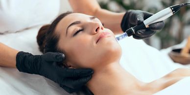 microneedling Burlington and RF microneedling for scars