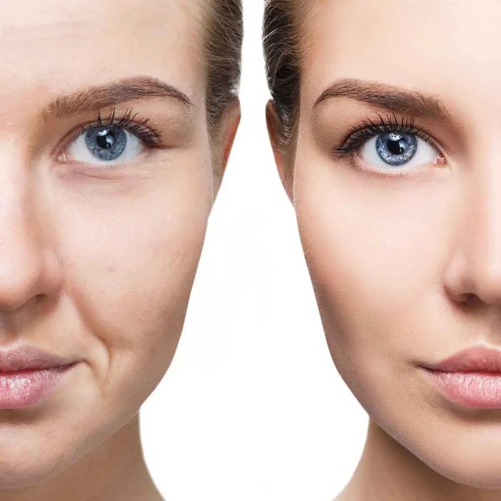 Facial Skin Castle Hill Microneedling beauty salon