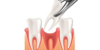 Wendover Dentist Tooth Extraction