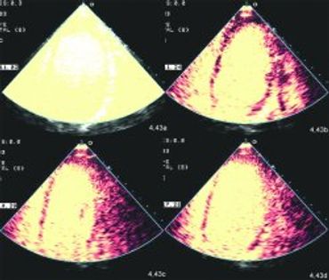 la ecocardiografía de estrés disponible en nuestra Clínica