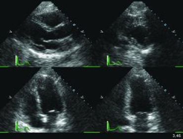 tenemos todas las modalidades de ecocardiografía