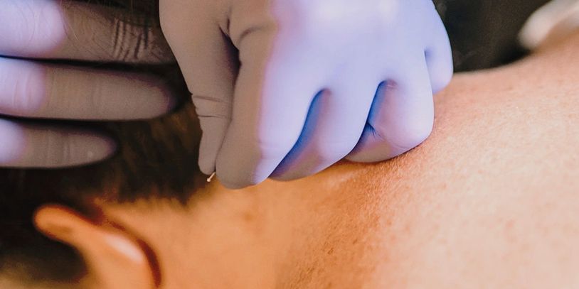 chiropractor placing dry needles in patient's neck