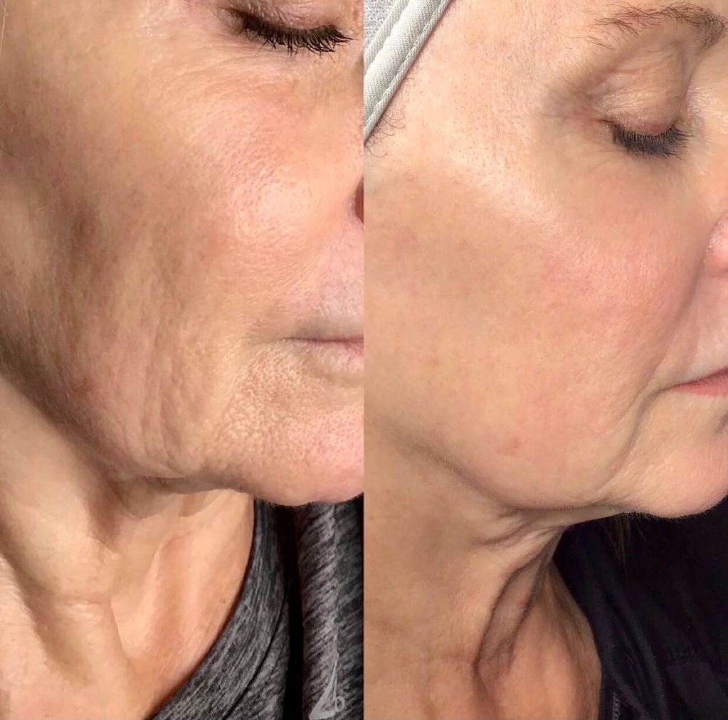 VirtueRF Microneedling with PRP or the PRP Facial.  Radiofrequency Microneedling Vero Beach