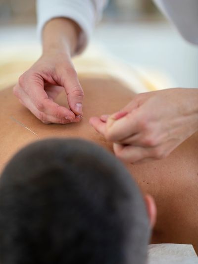 Dr. Nadia performing upper back acupuncture on a patient at Eastlake Acupuncture San Diego.