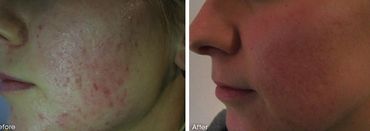 before and after miconeedling on acne scares.