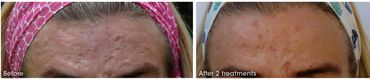 before and after image forehead acne scare treatment.