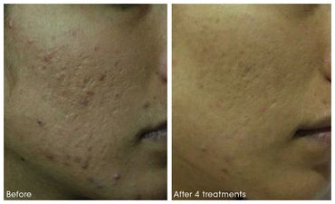 before and after results of microneedling on the cheeks.