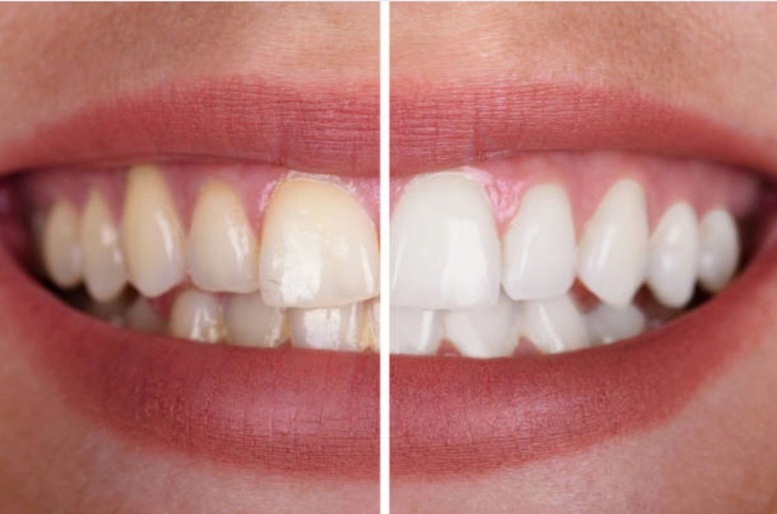 Before and after picture of professional LED teeth whitening.