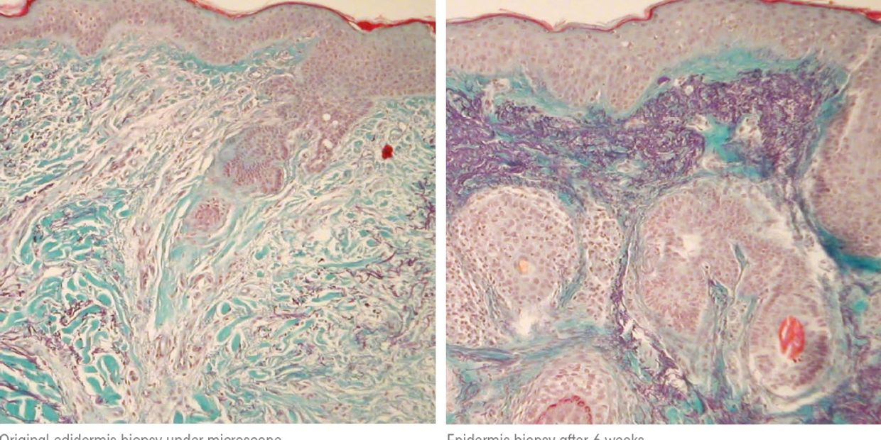 before and after collagen induction therapy using edermastamp microneedling.