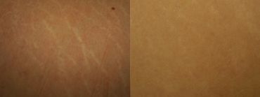 before and after results of microneedling on stretch marks.
