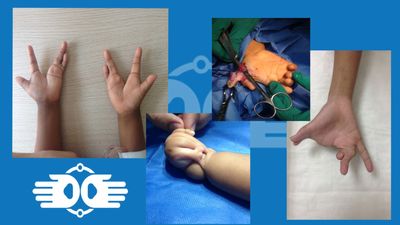 Enfermedades congénitas de la mano