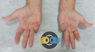 Contractura de Dupuytren