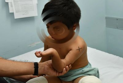 Lesiones del plexo braquial