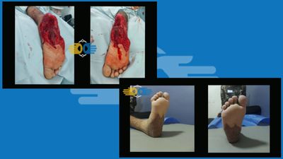 Reconstrucción de extremidades