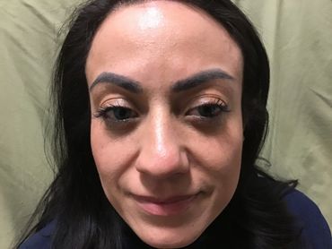 Juvederm Fillers for Nasolabial Folds Before