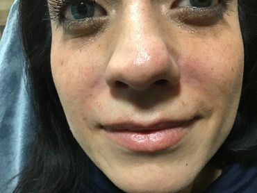 Juvederm Fillers after pics- Nasolabial Folds