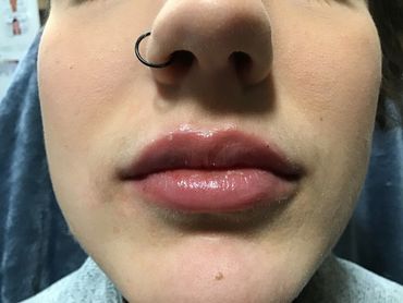Lip Fillers Juvederm