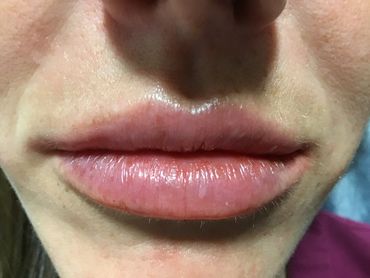 Lip Fillers Juvederm
