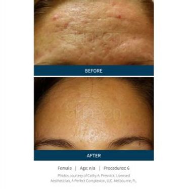 Microneedling