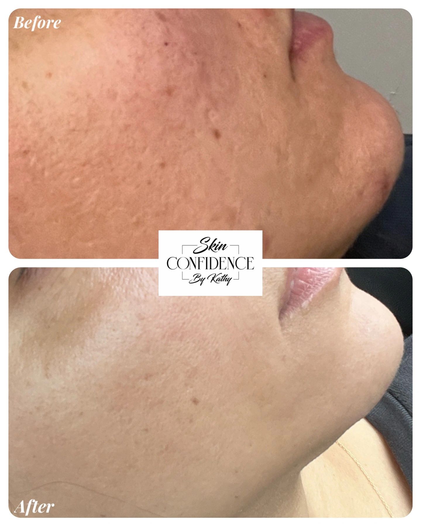 Before and after image our client who struggled with unhealthy skin.