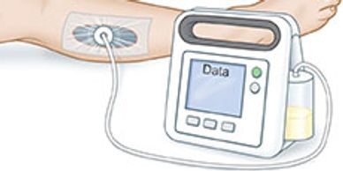 NPWT, Negative Pressure Wound Therapy, Wound Vac, Vacuum Assisted Closure, VAC
