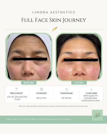 Before and after full-face skin treatment showing improved structure, skin quality and hydration at Linora Aesthetics