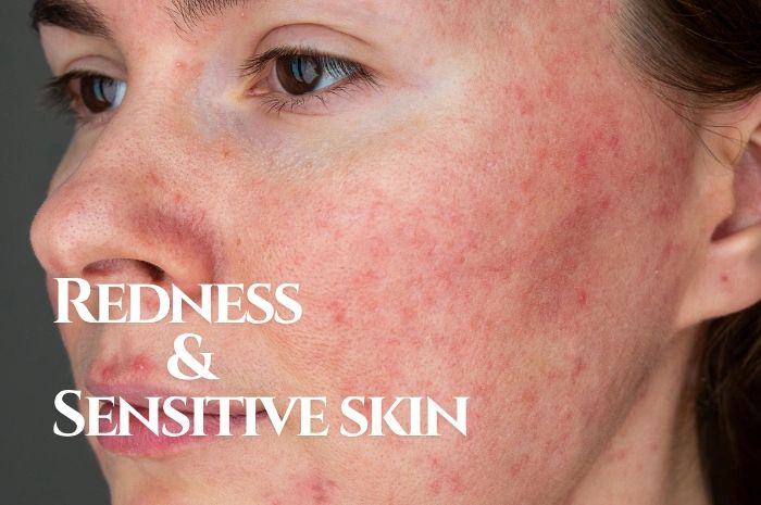 Close-up of a face with redness and sensitive skin.
