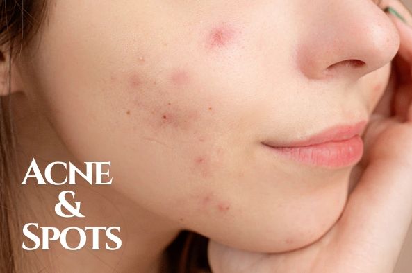 Close-up of acne and spots on a woman's cheek.