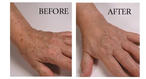 Pure Radiance Natural Skin Care before and after results after use of skin spot corrector