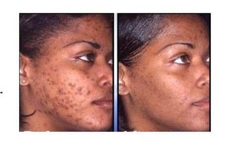 Pure Radiance Natural Skin Care before and after results with Retin A Cream and Retinol Treatment