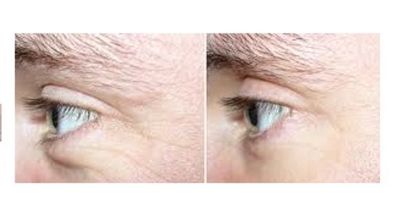 Pure Radiance Natural Skin Care before and after results using Time Freeze Eye Cream