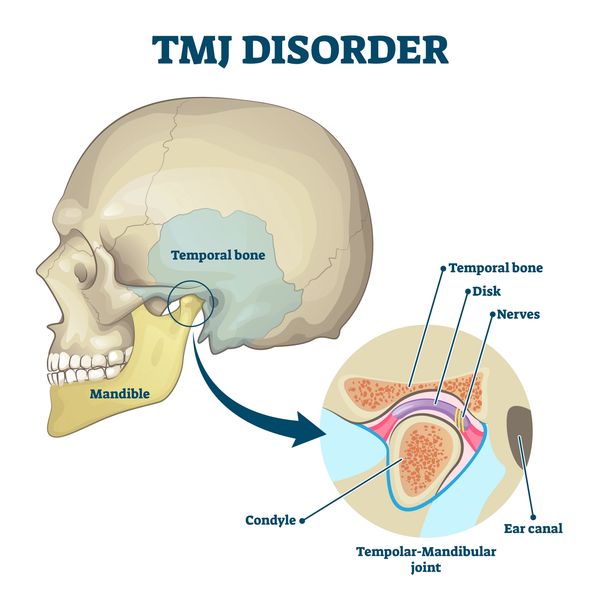 TMJ/TMD Treatment at Global Smiles Dental in Indianapolis, Indiana 46237. We Accept Medicaid.