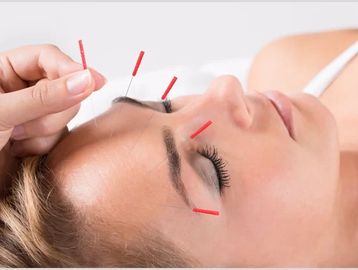 acupuncture in guelph