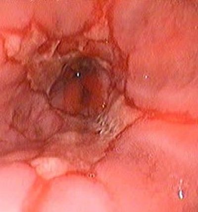 bursa reflü, bursa reflü cerrahisi, bursa reflü tedavisi, reflü cerrahisi bursa, bursa, reflü,cerrah