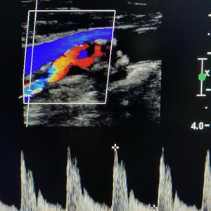 Ultrasound image of plaque in an artery. Vascular surgery. Vascular surgeon. 
