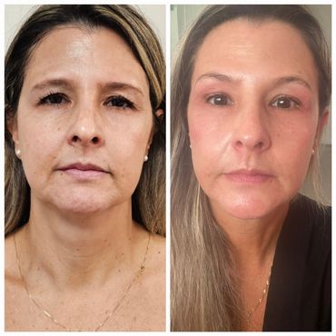 Laser Lift & Resurface
Cumulative Results