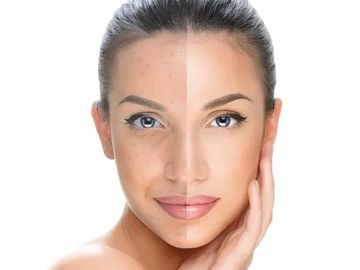 anti wrinkle treatment ageing skin cosmetic treatment pigmentation filler skincare sun spots removal