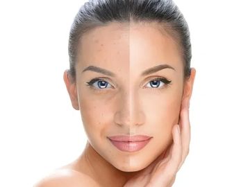 pigmentation removal collagen production pores cosmetic facials anti ageing best dermamelan cosmelan