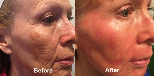 Laser skin resurfacing