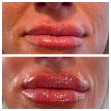 lip augmentation correction, lip filler before and after