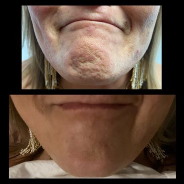 Chin botox before and after