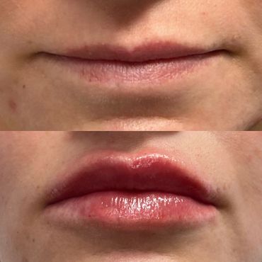 Lip augmentation before and after
