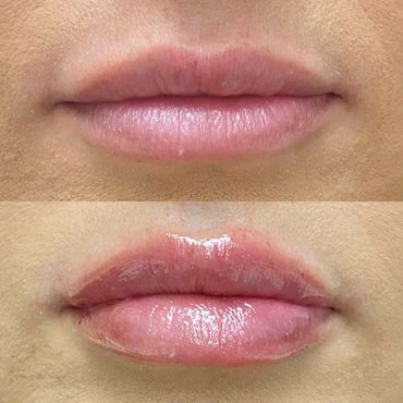 lip augmentation, lip filler before and after