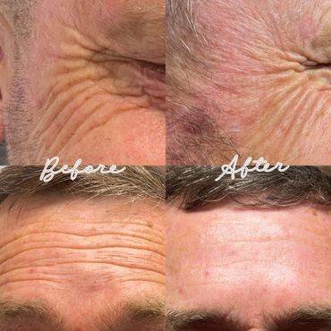 botox before and after, xeomin results, botox for men