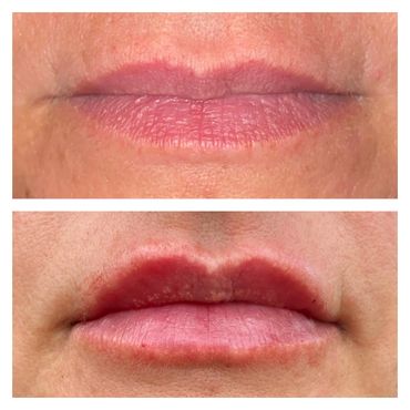 Lip augmentation, Lip filler before and after