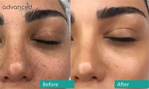 Micro-Needling, Dermaplaning, Hydra Facial, Cavitation and Laser Peels Southlake, TX Colleyville, TX