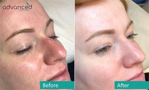 Micro-Needling, Dermaplaning, Hydra Facial, Cavitation and Laser Peels Southlake, TX Colleyville, TX