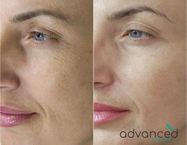 Micro-Needling, Dermaplaning, Hydra Facial, Cavitation and Laser Peels Southlake, TX Colleyville, TX