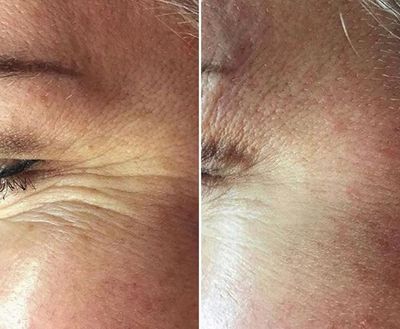 Anti-wrinkle injections with botox in wetherby and york smooth skin  lines and wrinkles