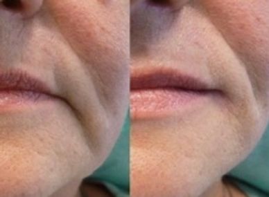 Dermal filler for marionette and nado-labial folds to smooth lines and downturned sad mouths
